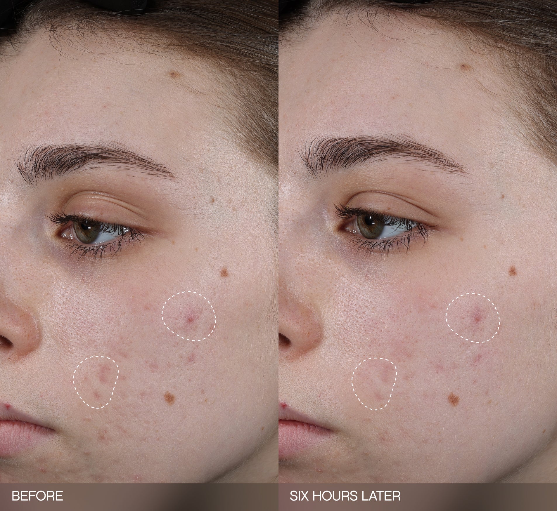 Patches for dark spots before-and-after showing visibly reduced acne marks on a fair-skin-tone model's cheek after just six hours of use.