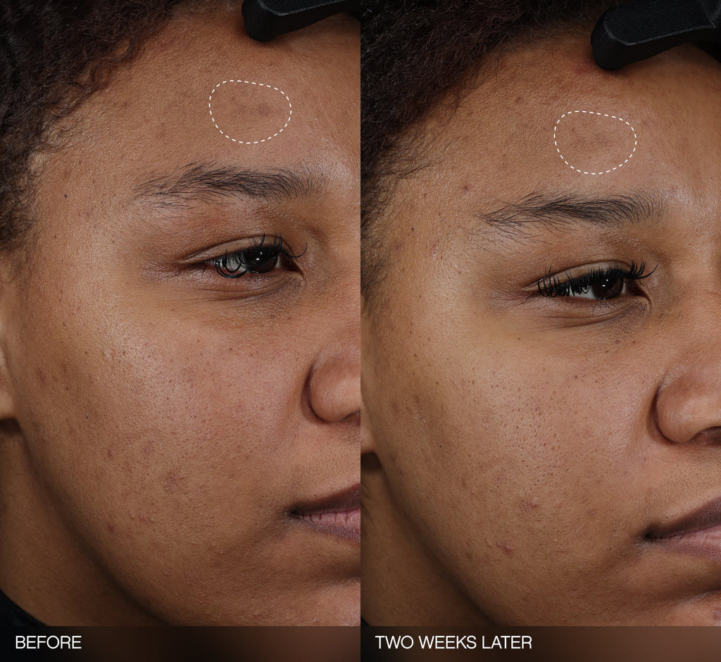 Dark spot remover for dark skin before-and-after showing a visibly faded forehead dark spot on a medium-skin-tone model after two weeks of use.