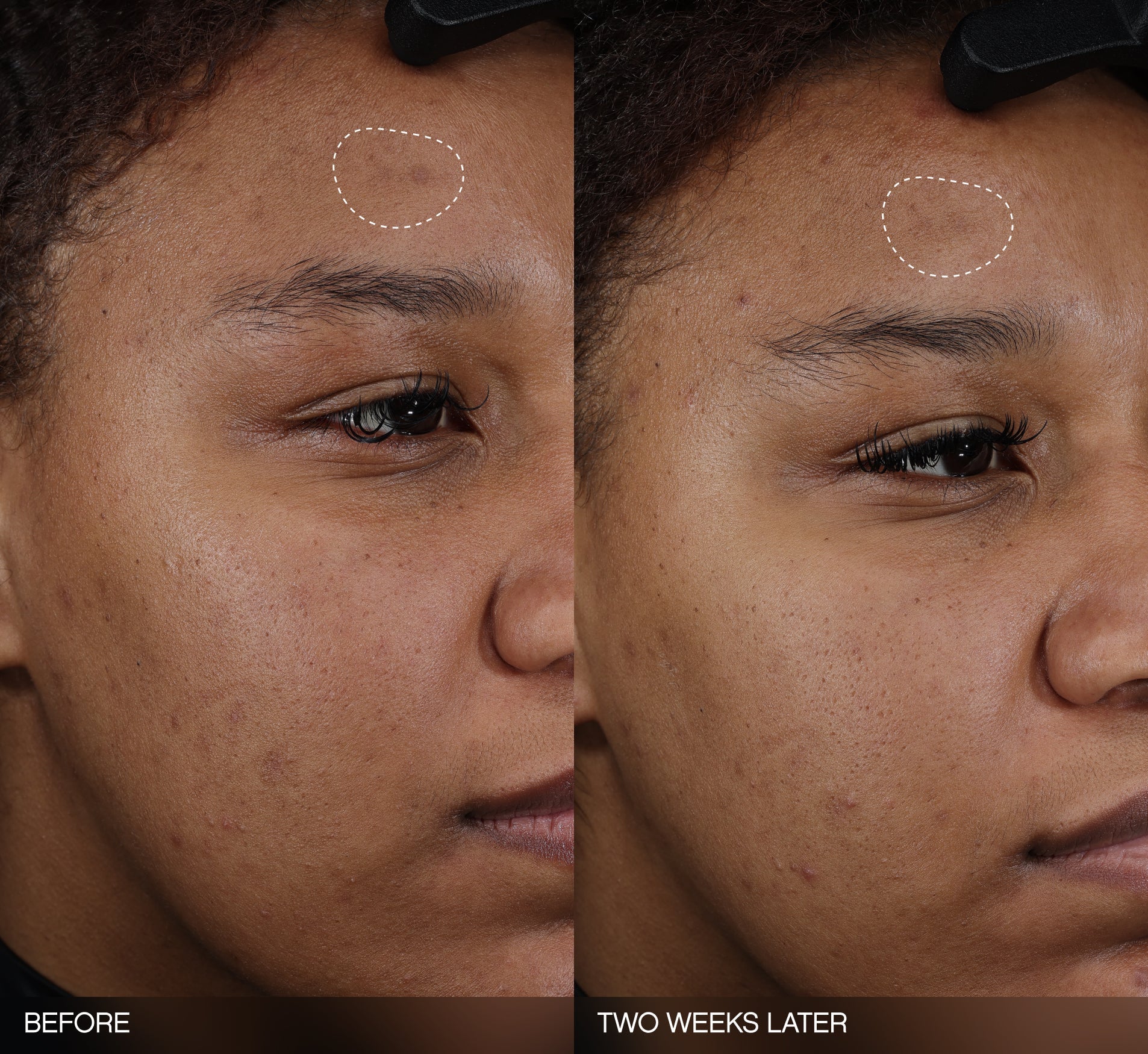 Dark spot remover for dark skin before-and-after showing a visibly faded forehead dark spot on a medium-skin-tone model after two weeks of use.
