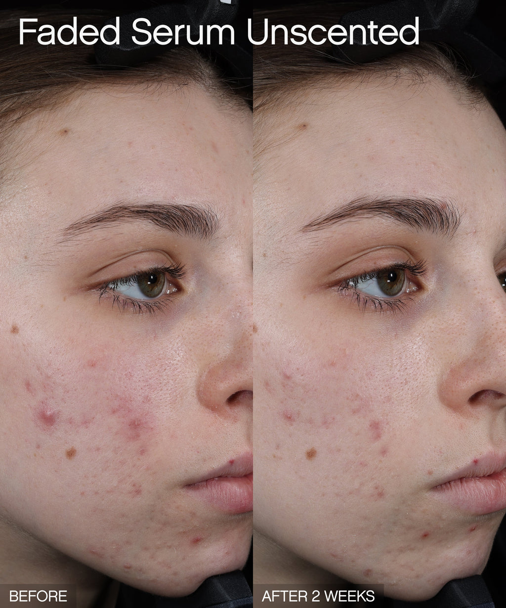 Brightening serum before and after comparison showing visibly reduced acne and dark spots on a person's cheek after two weeks of using Topicals Faded Unscented.