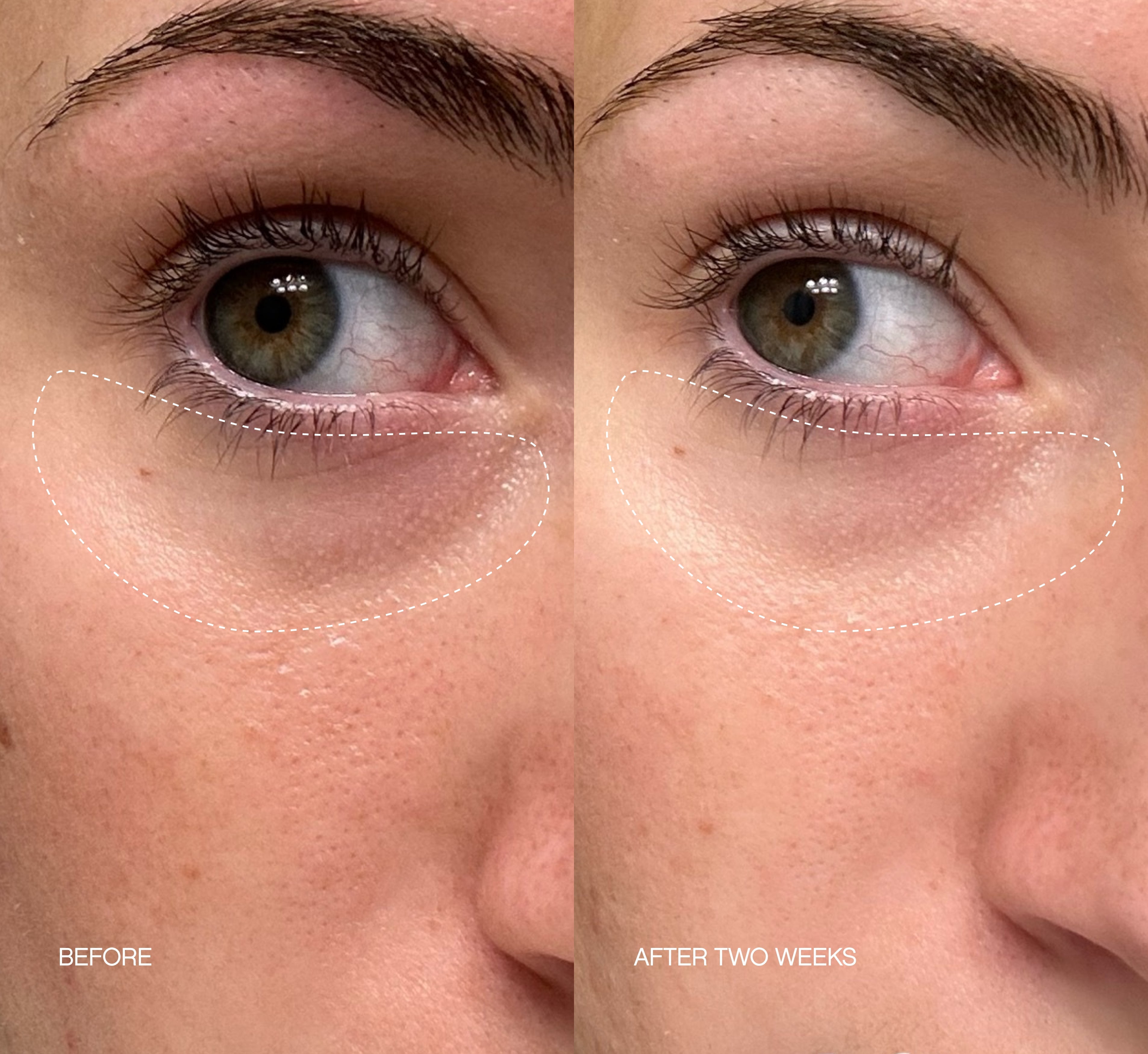 Brightening under eye patches before-and-after showing visibly reduced dark circles and puffiness after two weeks of use.